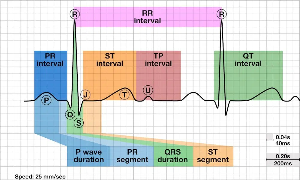 infographics of R-R intervals